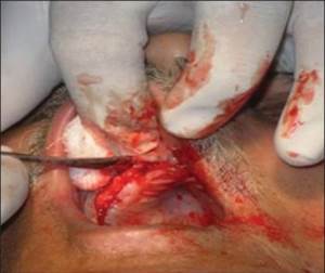 http://www.jdrntruhs.org/articles/2013/2/4/images/JNTRUnivHealthSci_2013_2_4_292_122177_f4.jpg