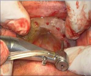 http://www.jdrntruhs.org/articles/2013/2/4/images/JNTRUnivHealthSci_2013_2_4_292_122177_f5.jpg