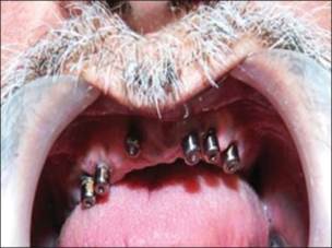 http://www.jdrntruhs.org/articles/2013/2/4/images/JNTRUnivHealthSci_2013_2_4_292_122177_f8.jpg
