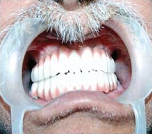 http://www.jdrntruhs.org/articles/2013/2/4/images/JNTRUnivHealthSci_2013_2_4_292_122177_f9.jpg